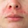 Perioral Dermatitis