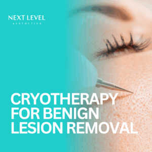 Cryotherapy for Benign Lesion Removal