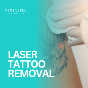 LASER Tattoo Removal